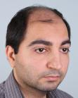 Before Hair Transplant&nbsp;Front